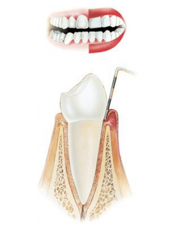 Зубной гингивит