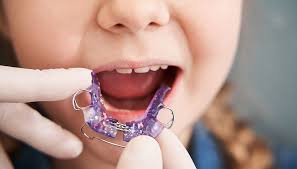 детская пластина для зубов 