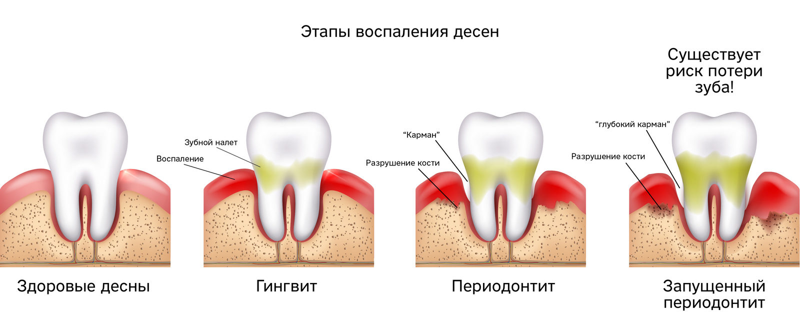 этапы воспаления десен лечение десен