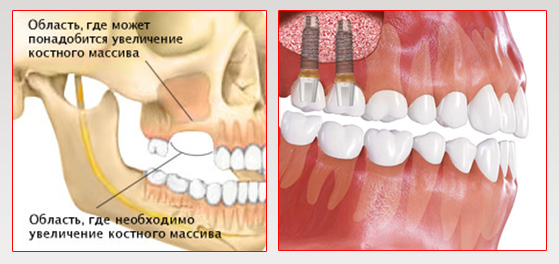 операция «Синус-лифтинг» синус-лифтинг