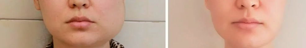 отек на нижней челюсти как выглядит отек после имплантации зубов