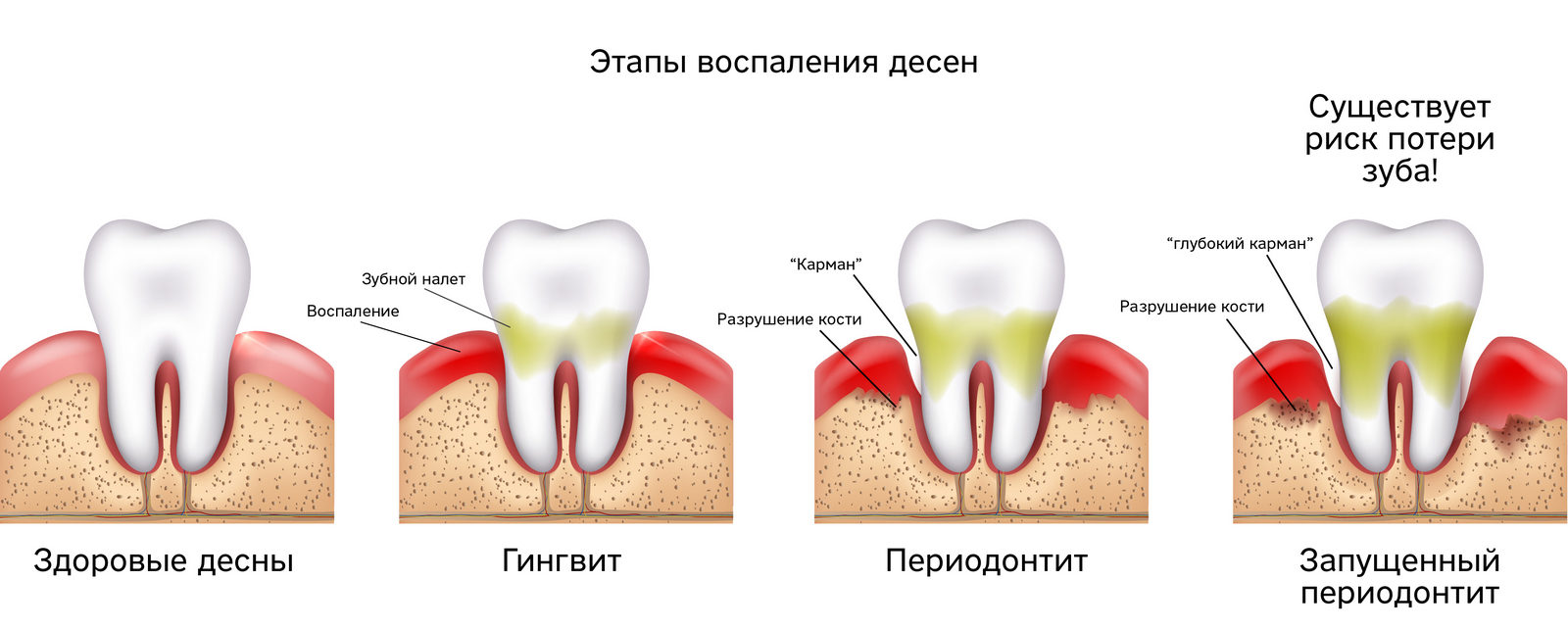 лечение десен